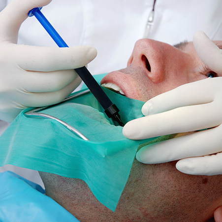 Root Canal Services